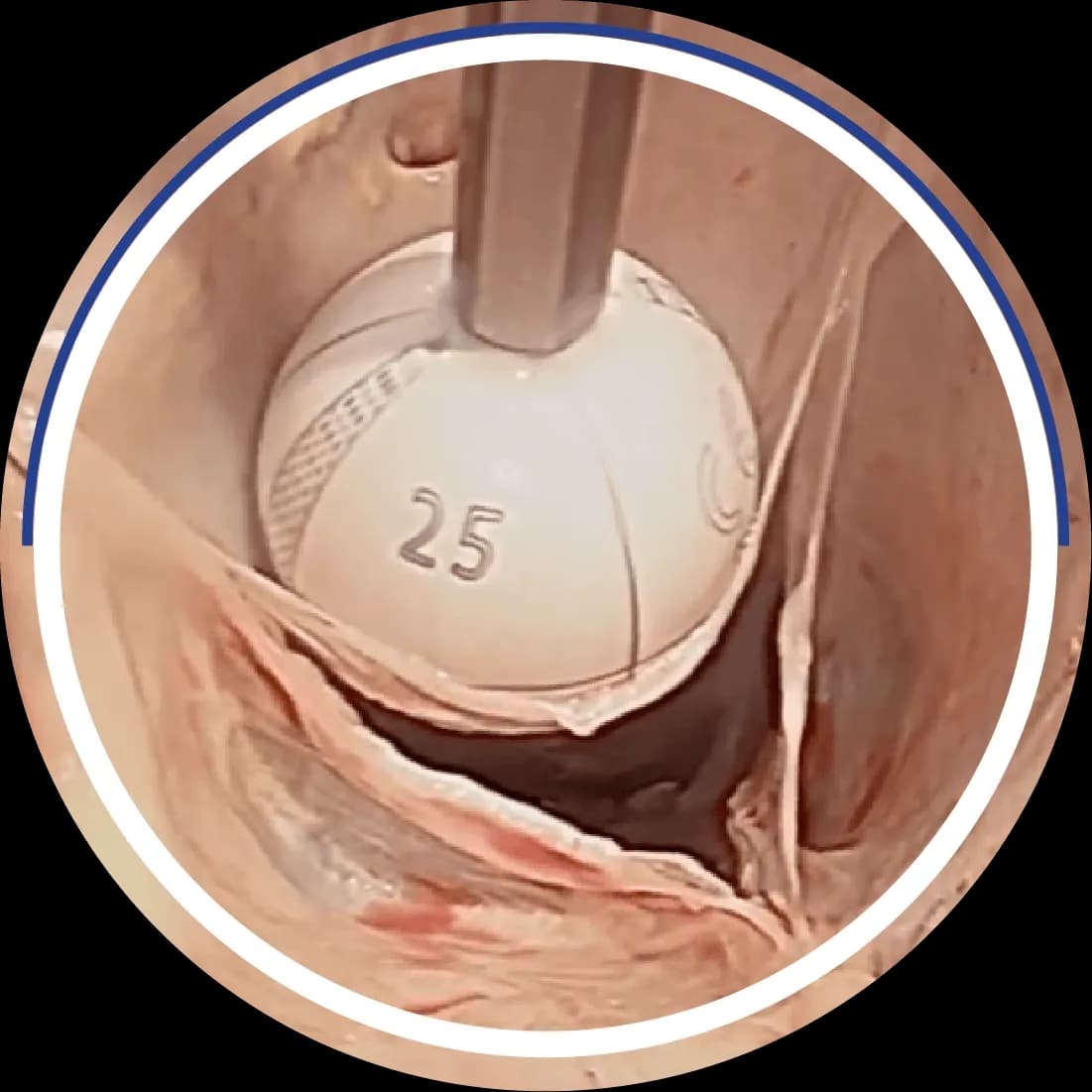 Intraoperative photo showing a size-25 HAART sizer tool placed inside the aortic root to measure leaflet free-edge length for objective device sizing