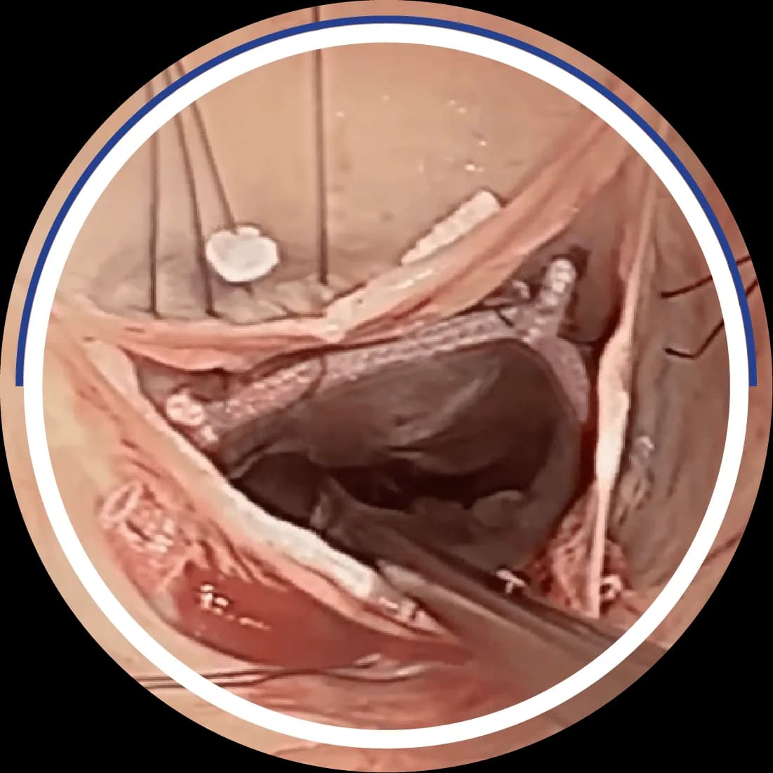 Intraoperative photo showing HAART 300 annuloplasty device placed internally sub-valvularly in the aortic root, with mesh-covered ring, sutures, and surgical instruments visible