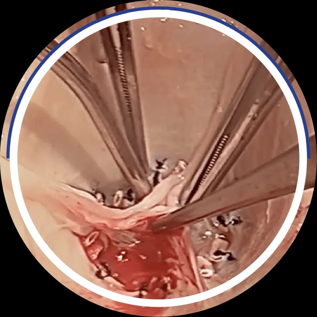 Intraoperative photo of aortic valve leaflet reconstruction with instruments retracting leaflets during HAART 300 repair