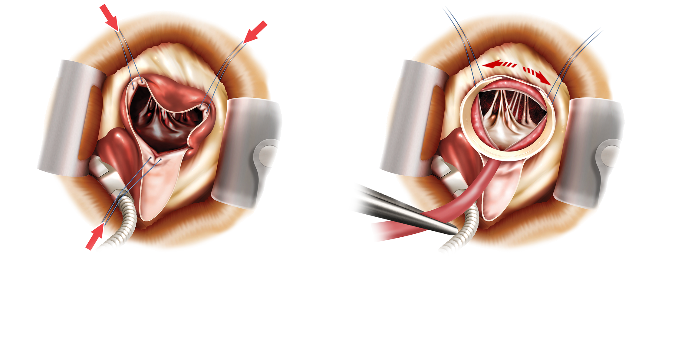 circumferential retraction